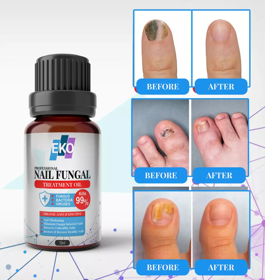 Anti Fungal Treatment Fungus Effective Finger Toe Nail Repair Solution UK 10ml