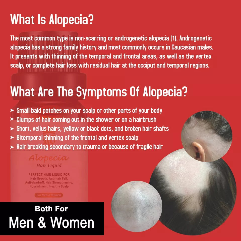 ALOPECIA ANTI HAIR LOSS TREATMENT FOR HAIR FALL,BEARD\BROW LOSS 10ML UK